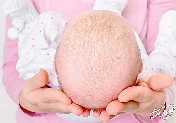 علائم پوسته سر نوزدان پوسته سر نوزادان